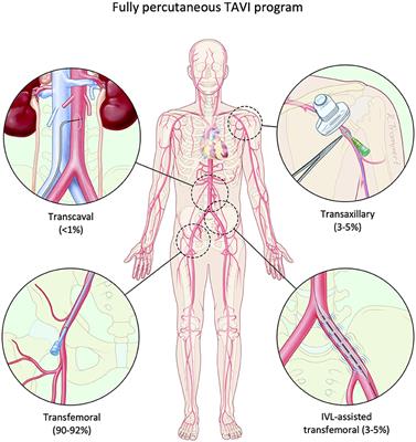 Frontiers Intravascular Lithotripsy Assisted Transfemoral Tavi The Copenhagen Experience And Literature Review Cardiovascular Medicine