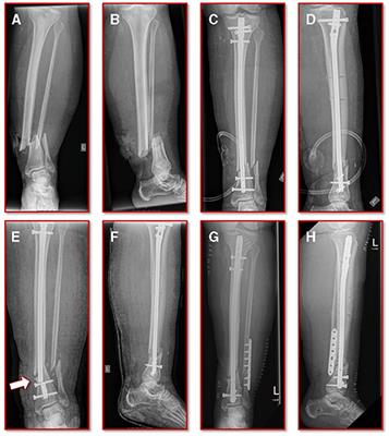 Frontiers | Individualized Determination of the Mechanical Fracture Environment After Tibial Exchange Nailing—A Simulation-Based Feasibility Study Frontiers | Individualized Determination of the Mechanical Fracture Environment After Tibial Exchange Nailing—A Simulation-Based Feasibility Study