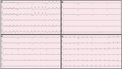 Case Report: Acute Fulminant Myocarditis and Cardiogenic Shock After Messenger RNA Coronavirus Disea...