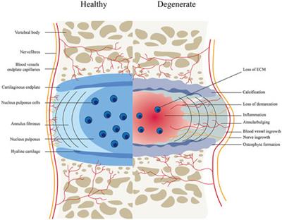 Frontiers | Mesenchymal Stem Cell-Derived Exosomes As A Novel Strategy For  The Treatment Of Intervertebral Disc Degeneration