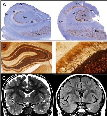 Entanglement Mockingbird Beforehand Frontiers | Pathological Targets for Treating Temporal Lobe Epilepsy: Discoveries From Microscale to Macroscale Entanglement Mockingbird Beforehand Frontiers | Pathological Targets for Treating Temporal Lobe Epilepsy: Discoveries From Microscale to Macroscale