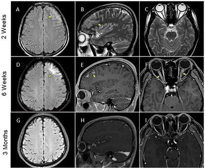 anti mog demyelinating disease anti mog demyelinating disease