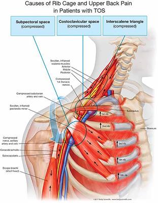Frontiers  Diagnostic and Therapeutic Management of the Thoracic Outlet  Syndrome. Review of the Literature and Report of an Italian Experience