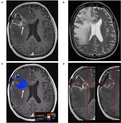 brain scan with tumor