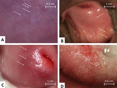 Frontiers | Female Genital Schistosomiasis Lesions Explored Using Circulating Anodic Antigen as an Indicator for Live Schistosoma Worms