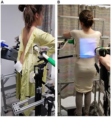 Frontiers  Immediate Outcomes and Benefits of 3D Printed Braces for the  Treatment of Adolescent Idiopathic Scoliosis