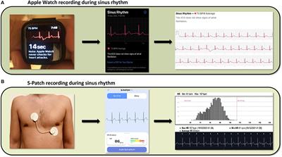 Frontiers  A Pilot Study of Blood Pressure Monitoring After Cardiac  Surgery Using a Wearable, Non-invasive Sensor