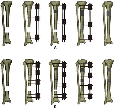 Tibia Fractures: Ilizarov / Circular Wire Fixators : Wheeless' Textbook of  Orthopaedics