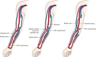 brachial cephalic fistula