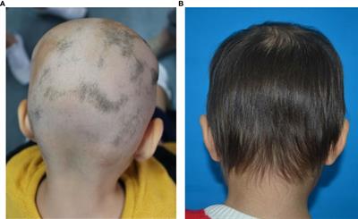 Top Causes of Hair Loss for Women
