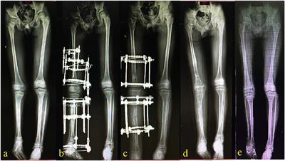 Full-ring Ilizarov frame applied for lengthening of tibia.