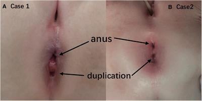 Frontiers | Case Report: Anal canal duplication associated with anorectal  stenosis—A rare presentation