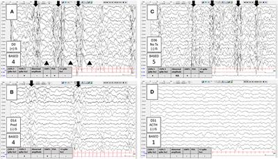 Long-Term Video EEG Monitoring - Children's Hospital of Orange County