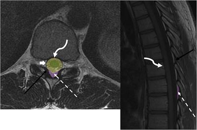 ventral epidural space