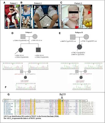 Frontiers  Case report: A preterm infant with rubinstein-taybi