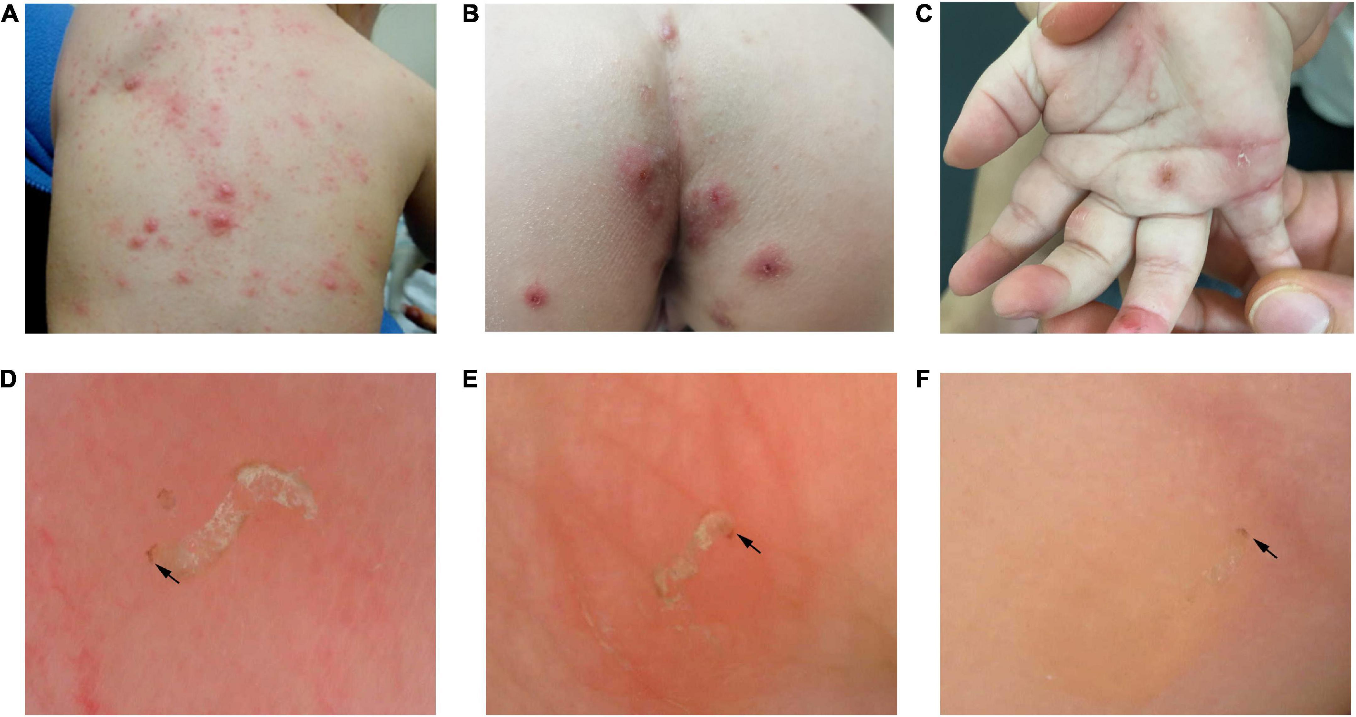Scabies Larvae: Identification and Treatment