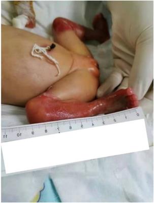 Frontiers  Case report: A preterm infant with rubinstein-taybi