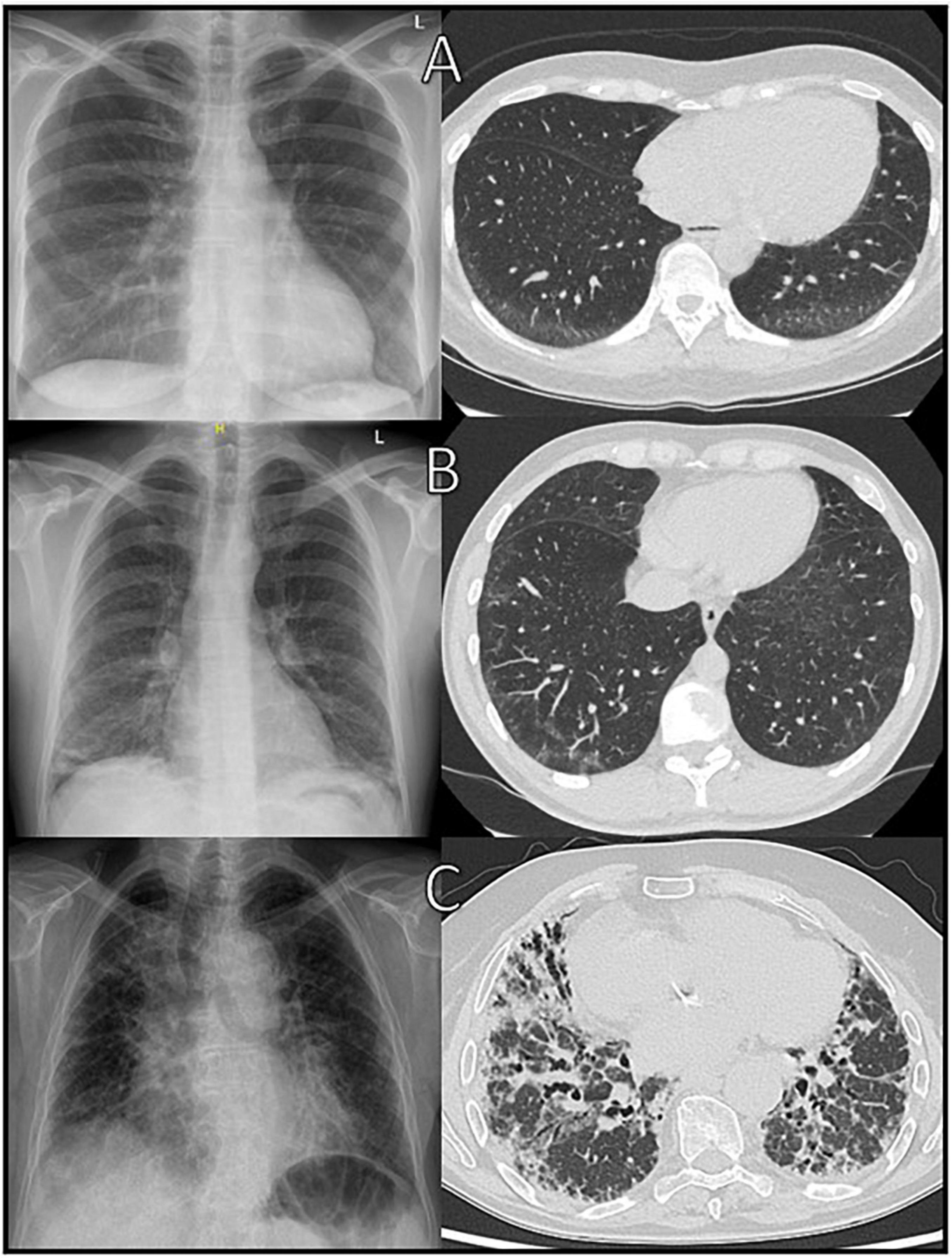Frontiers | Diagnosing lung involvement in inflammatory rheumatic 