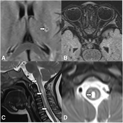 Frontiers  Case report: A preterm infant with rubinstein-taybi