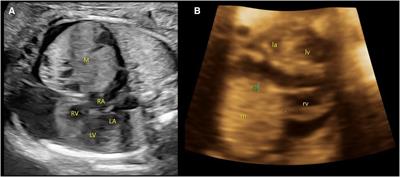 Frontiers  Case report: A preterm infant with rubinstein-taybi