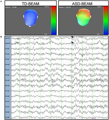 Frontiers  Case report: A preterm infant with rubinstein-taybi