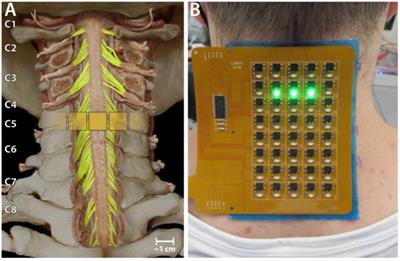 Frontiers  Intrafamilial variability in SLC6A1-related neurodevelopmental  disorders