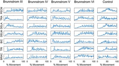 Brunnstrom Stages Of Recovery Chart Pdf