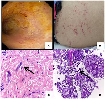 a strongyloidosis helmintus