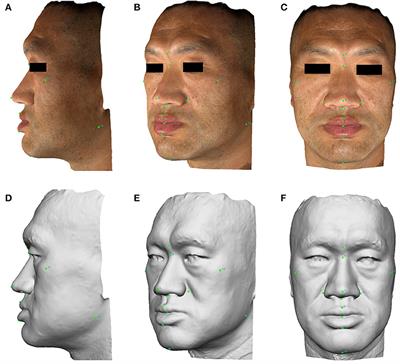 Frontiers | 3D Facial Analysis in Acromegaly: Gender-Specific Features ...