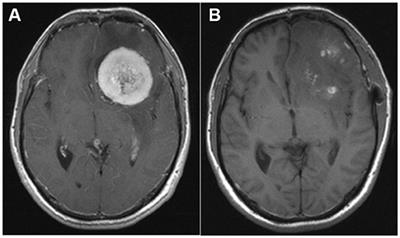 Postoperative Headache List Of Frontiers Open Access Articles