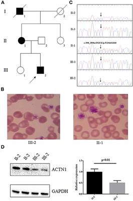 Frontiers  Case report: A preterm infant with rubinstein-taybi