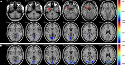 Frontiers  Abnormal brain spontaneous activity in major