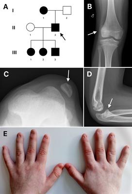 autosomal dominant disorder - List of Frontiers' open access articles autosomal dominant disorder - List of Frontiers' open access articles