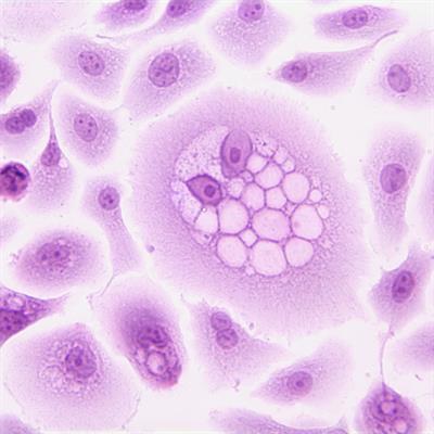 papilloma vírus vagy tumor)